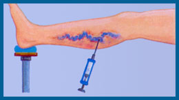 tratamiento-esclerosante-1